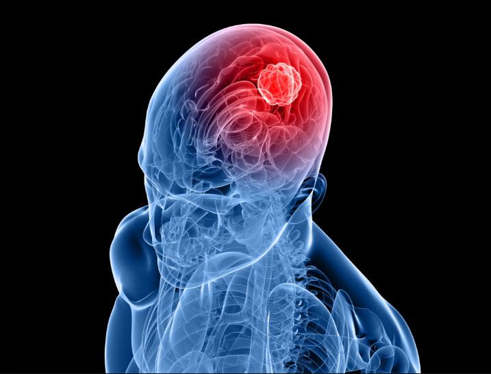 أعراض سرطان الدماغ وأنواعه والعلاج