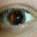 أسباب وأعراض ارتفاع ضغط العين