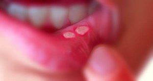 علاج تقرحات الفم في المنزل والأسباب التي تؤدي إلى ظهورها