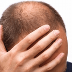 6 نصائح مهمة لتجنب الصلع وتفادي تساقط الشعر