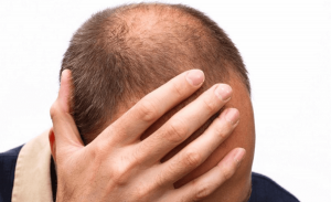 6 نصائح مهمة لتجنب الصلع وتفادي تساقط الشعر