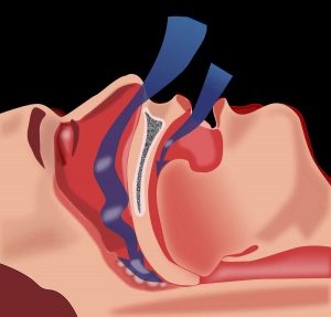 متلازمة انقطاع التنفس أثناء النوم … الشخير