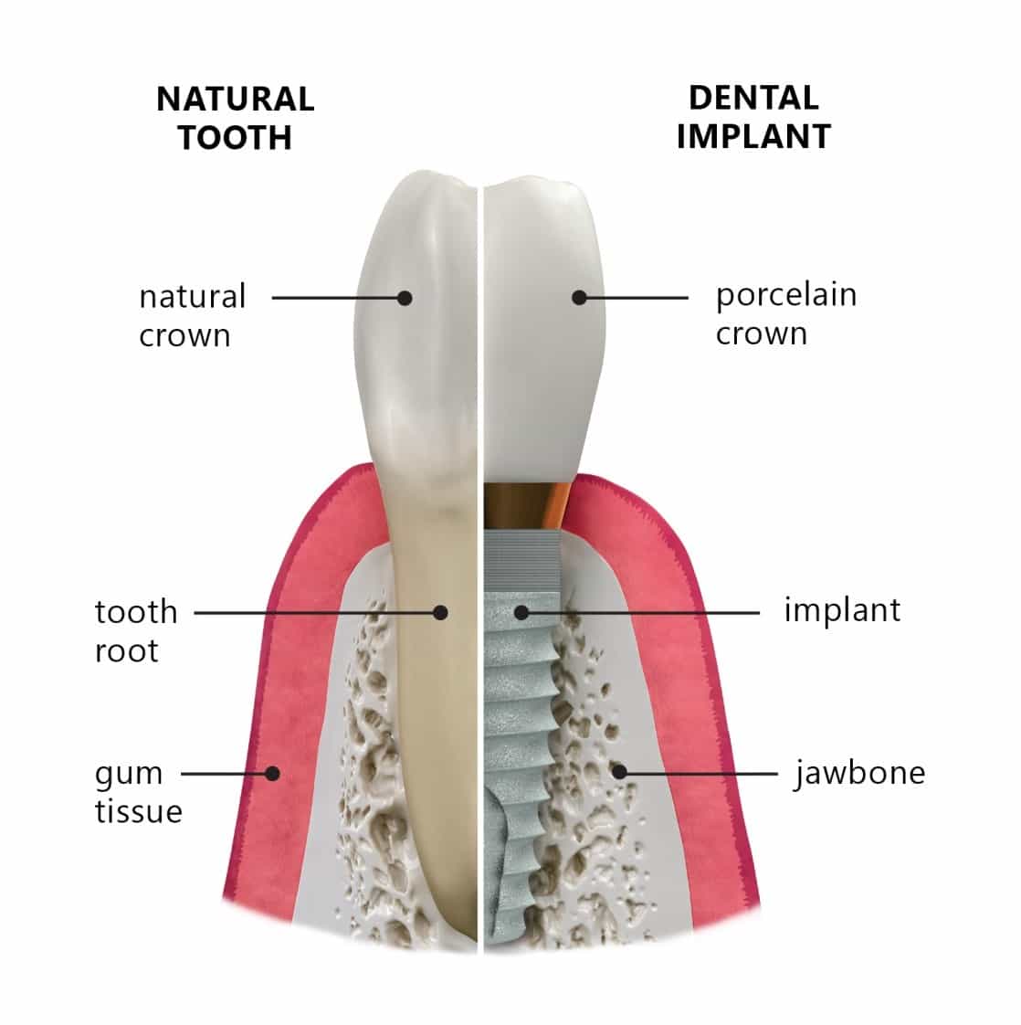 نوعية الأسنان التي تتم زراعتها