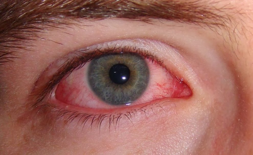 حساسية العين في الربيع عند الأطفال أسبابها وطرق الوقاية منها إستفادة ...