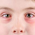 حساسية العين في الربيع عند الأطفال أسبابها وطرق الوقاية منها