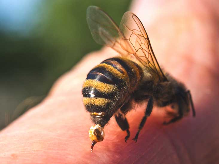 أشكال الإصابات التي تعالج بلسعة النحل