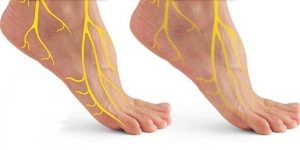 ما الذي يسبب التهاب أعصاب القدم؟ وكيف يتم معالجته؟