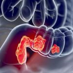 أعراض سرطان القولون عند النساء