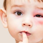 أسباب وأعراض و علاج التهاب العين عند الأطفال