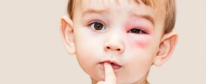 ما هي أسباب وأعراض و علاج التهاب العين عند الأطفال وطرق الوقاية منه؟