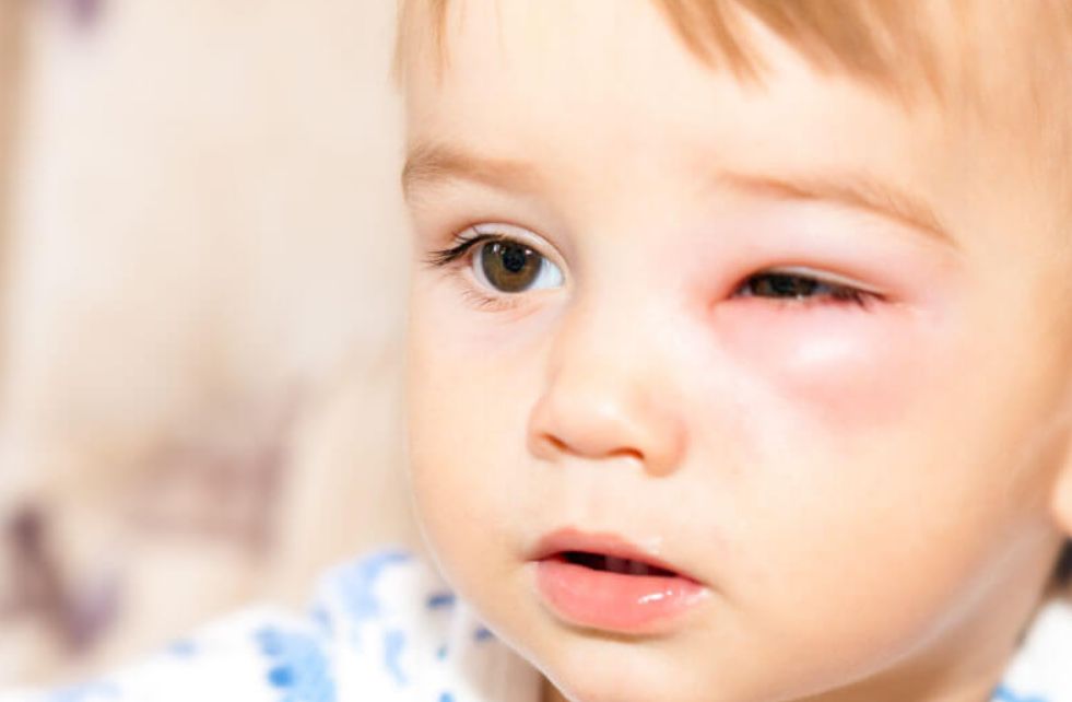 أعراض التهاب العين عند الأطفال