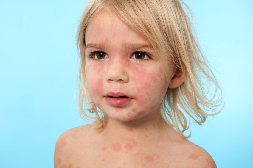 حساسية الجلد عند الأطفال بالصور مجلتك