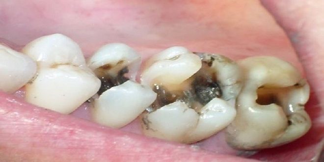 تجربتي مع علاج تسوس الأسنان بالأعشاب