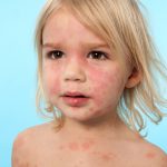 حساسية الجلد عند الأطفال بالصور