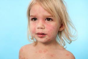حساسية الجلد عند الأطفال بالصور