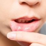 علاج قلاع الفم