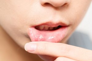 طرق علاج قلاع الفم