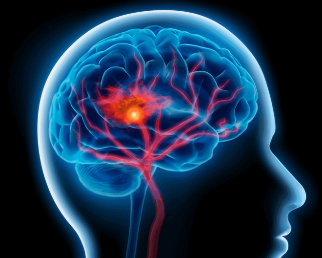 السكتة الدماغية – الأسباب والأعراض وعوامل الخطر