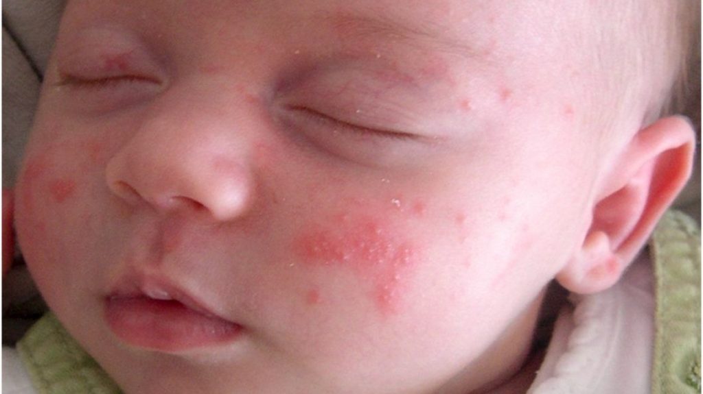 الامراض الجلدية عند الاطفال1