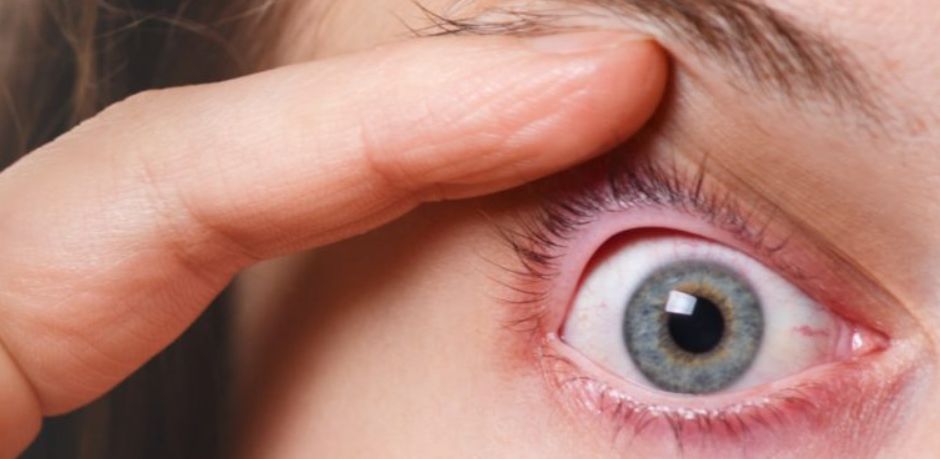 ما هي حساسية العيون ؟