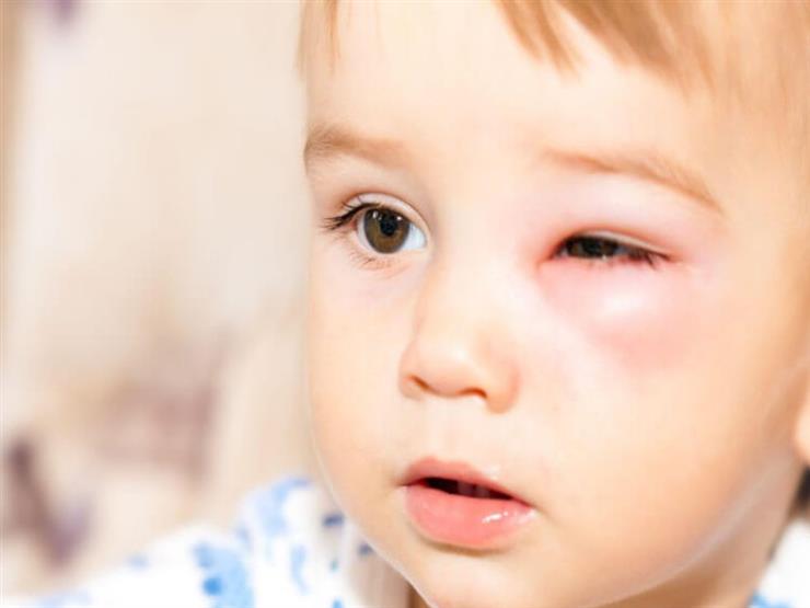 علاج بعض الأمراض التي تصيب العين عند الأطفال وطرق الوقاية منها إستفادة ...