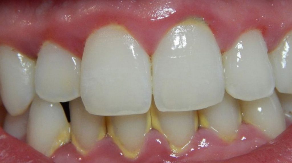 ما هو جير الأسنان ؟