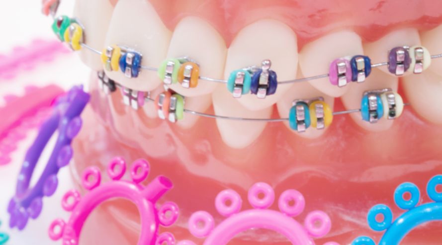 ألوان تقويم الأسنان والحفاظ عليها