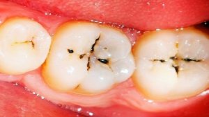 مراحل تسوس الأسنان والتدابيرالوقائية لمنعها