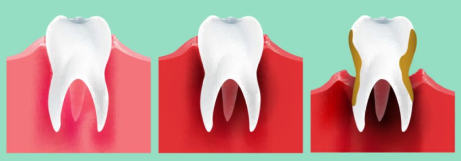 كيف يؤثر تراكم الجير على الأسنان واللثة؟