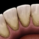 ما هي أسباب تراكم الجير على الأسنان وأضراره وطريقة التعامل معه؟