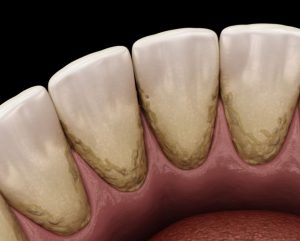 ما هي أسباب تراكم الجير على الأسنان وأضراره وطريقة التعامل معه؟