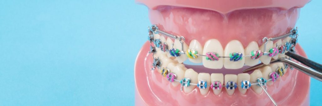 ماذا يفعل التقويم في الأسنان وكيف يصحح مشاكلها؟