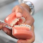 ماذا يفعل التقويم في الأسنان وما هي آلية عمله في تصحيح 12 حالة؟