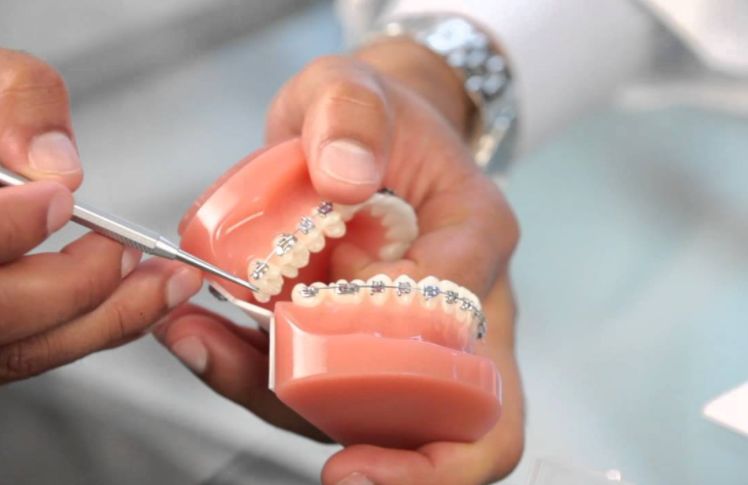 ماذا يفعل التقويم في الأسنان وما هي آلية عمله في تصحيح 12 حالة؟