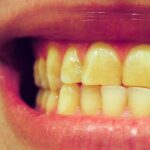 أسباب اصفرار الأسنان الـ 20 وكيف عليك التعامل مع كل منها
