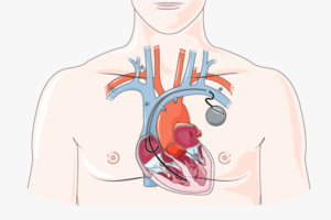 التعايش مع جهاز تنظيم ضربات القلب