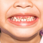 تخفيف ألم تسوس الأسنان عند الأطفال