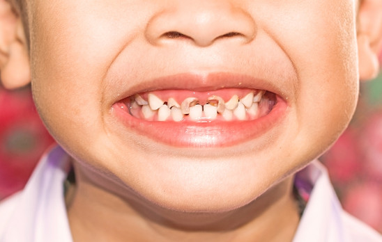 كيف يمكن تخفيف ألم تسوس الأسنان عند الأطفال وما هي طرق الوقاية؟