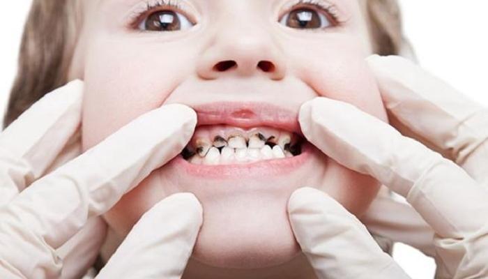 كيف يمكن علاج تسوس الأسنان عند الأطفال في المنزل؟