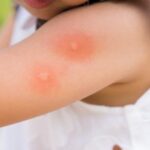 علاج لدغ الحشرات للأطفال