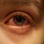 أسباب احمرار العين عند الاستيقاظ
