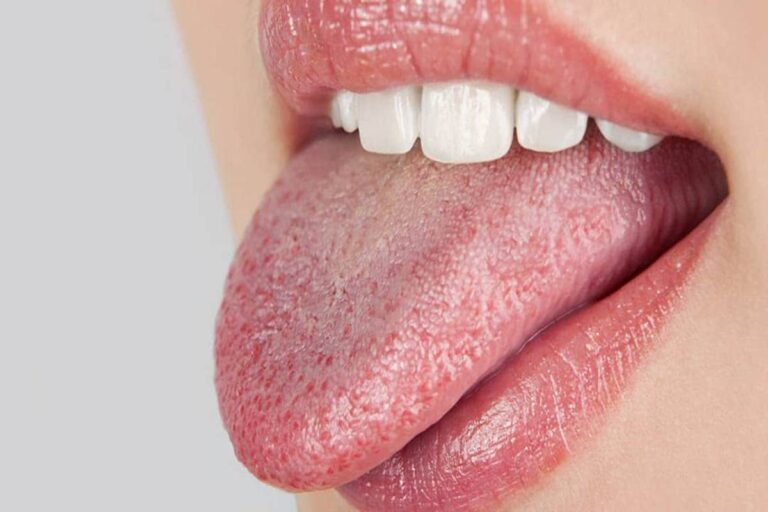 جفاف الفم من أعراض القولون