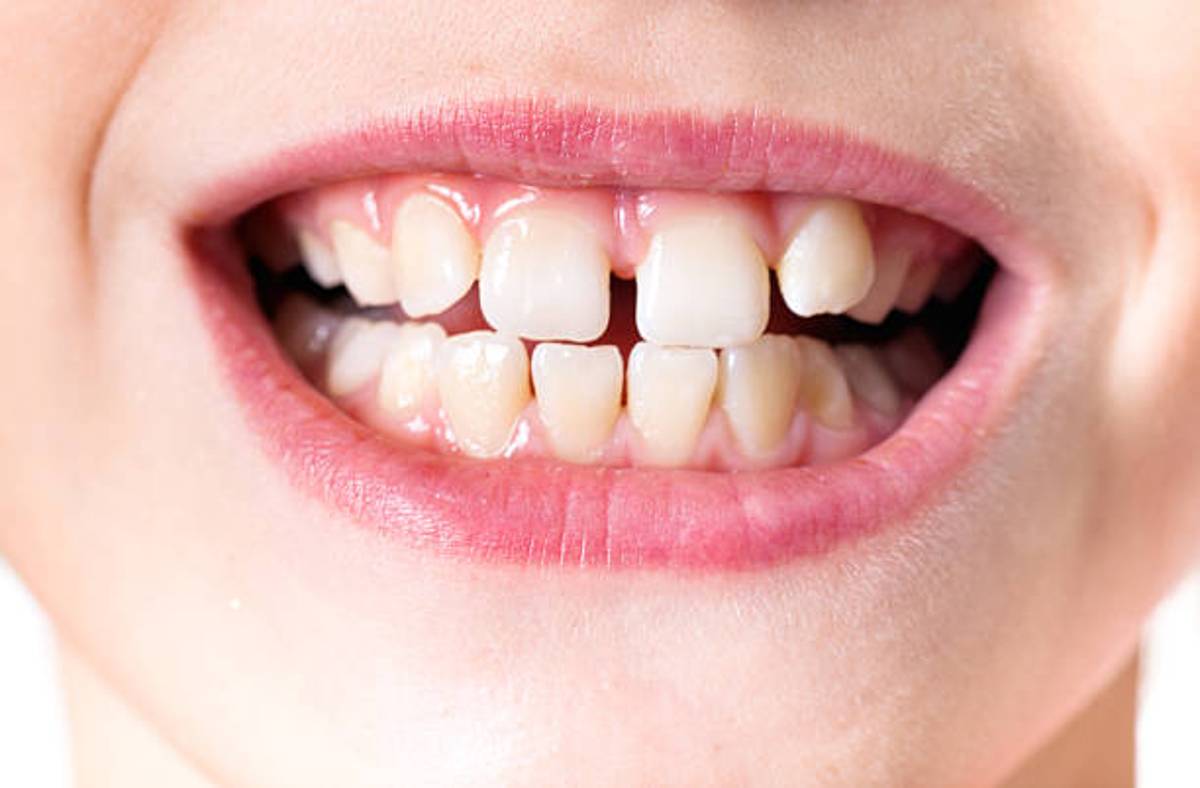 ما هو صرير الأسنان عند الأطفال؟ وكيف يمكن علاج هذه المشكلة؟