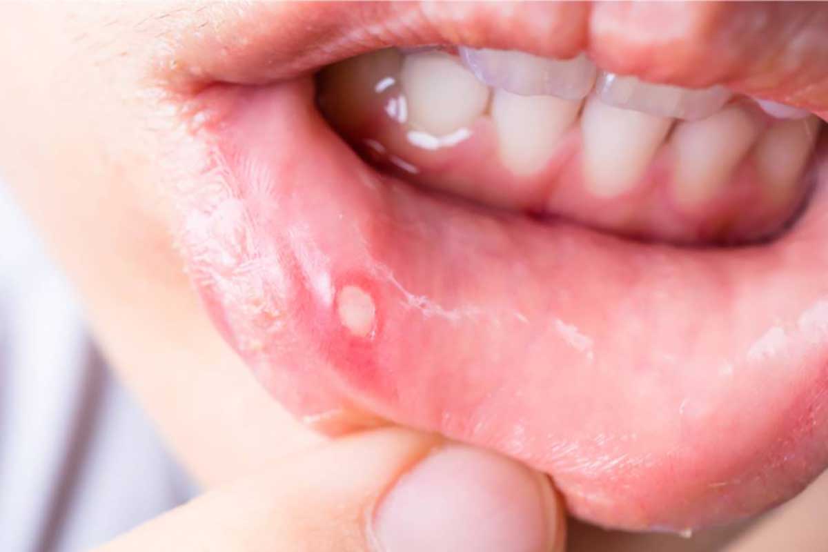 أهم المعلومات حول أسباب تقرحات الفم وطرق علاجها