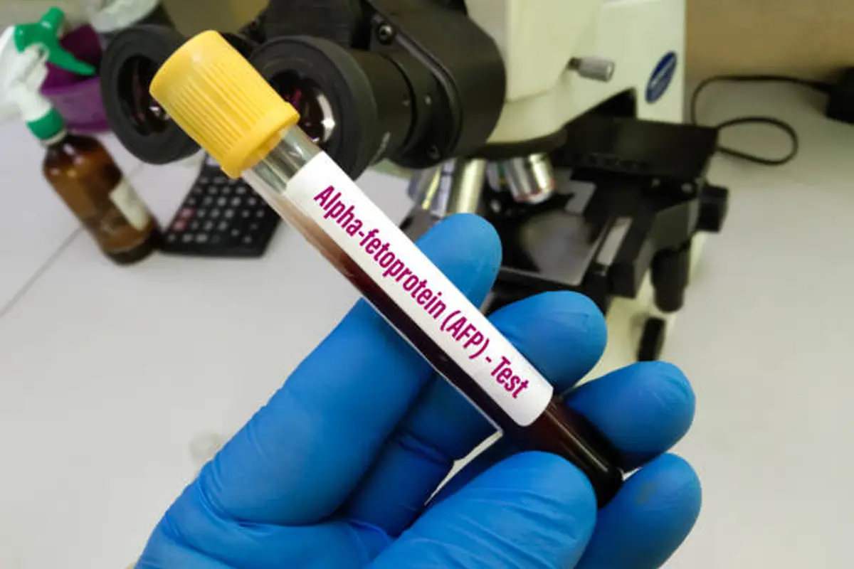 اختبار ألفا فيتوبروتين AFP – لماذا يستخدم؟ وما هي نتائجه؟